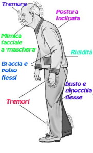 In uno schema i principali sintomi del morbo di Parkinson